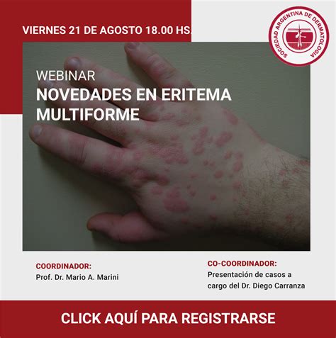 Webinar: Novedades en eritema multiforme – SAD