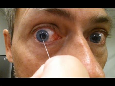 Mucus Strings In Eyes