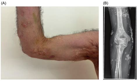 Calcinosis cutis in a young man with dermatomyositis | Rheumatology
