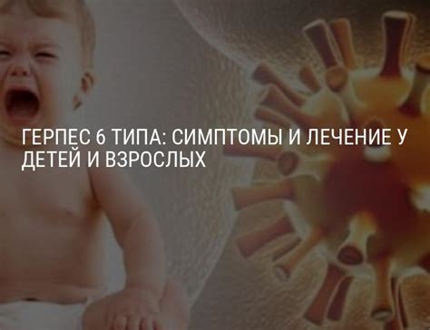 Герпес 6 типа: симптомы и лечение вируса герпеса 6 типа у детей и взрослых