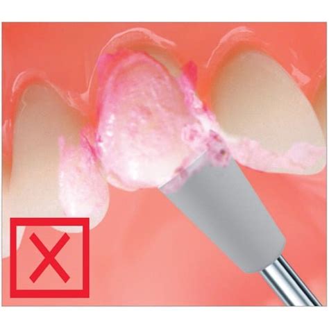 Polipant profilaxie 1235 - Dentamed