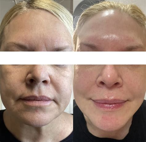 Sofwave Ultrasound Skin Tightening & Lifting Rochester NY