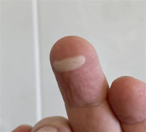 Burn blister on my finger looks like an Among Us character : r