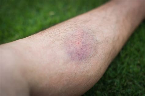 Feeling of Bruised Area on Leg but No Bruise: Should You Worry? » Scary ...