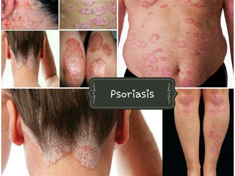 psoriasis ointment, Beauty & Personal Care, Foot Care on Carousell