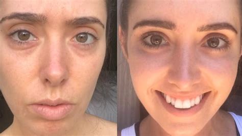 Stars Who Have Gotten Breast Implants Before After Pl - vrogue.co