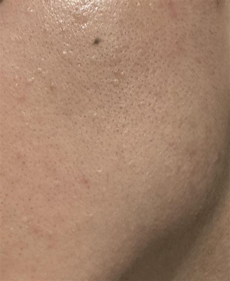 unknown bumps   face rskincareaddicts