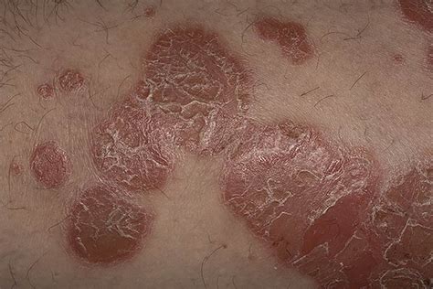Psoriasis skin rash pictures | Symptoms and pictures