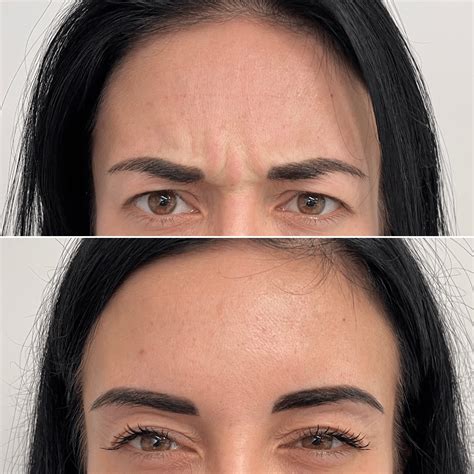Fronsrimpel met Botox - Laurium Klinieken