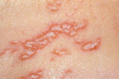 herpes simplex lesions  science photo library