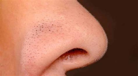 Cravo Branco No Rosto - Cravo no rosto, como se formam? Dicas para se livrar deles