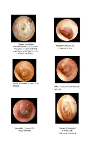 Tympanic membrane dr. fadil