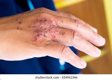 844 Ant Bite Skin Images, Stock Photos & Vectors | Shutterstock