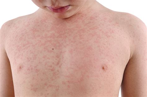 What to do if a Customer has an Allergic Reaction - Cafe Feedz - Food ...