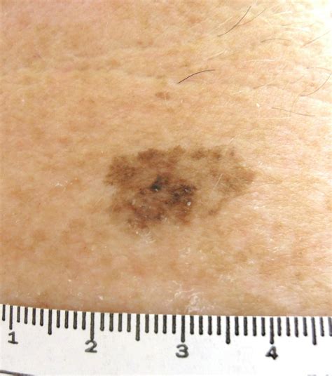 Early Stage Melanoma Pictures Melanomas Detected During Digital