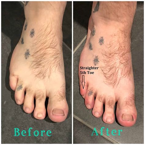 Listers/ Durlacher Corns - Foot and Ankle Pain Management