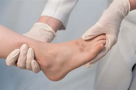 avulsion fractures treatment  singapore orthocare sg