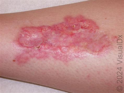 Recognizing Diabetes Through Skin Manifestations: A VisualDx Guide ...