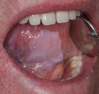 Mouth Infection – Causes of Mouth Infection - SkinnyZine