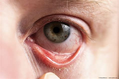 Allergic Conjunctivitis - Axis Eye Clinic