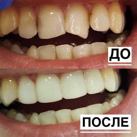 Эстетическая реставрация зубов в Ижевске | Стоматология АПЕКС