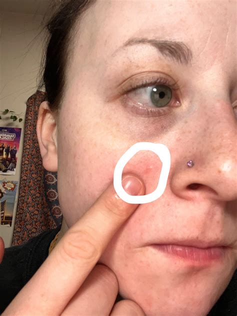 White bump on face : r/SkincareAddicts