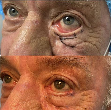 ectropion correction gallery soroudi advanced lasik eye centers