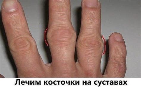 *ПОЛЕЗНЫЕ СОВЕТЫ ИЗ БАБУШКИНОЙ ШКАТУЛКИ* Лечим косточки на суставах ...
