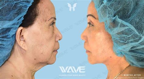 prepare   facelift  week checklist wave