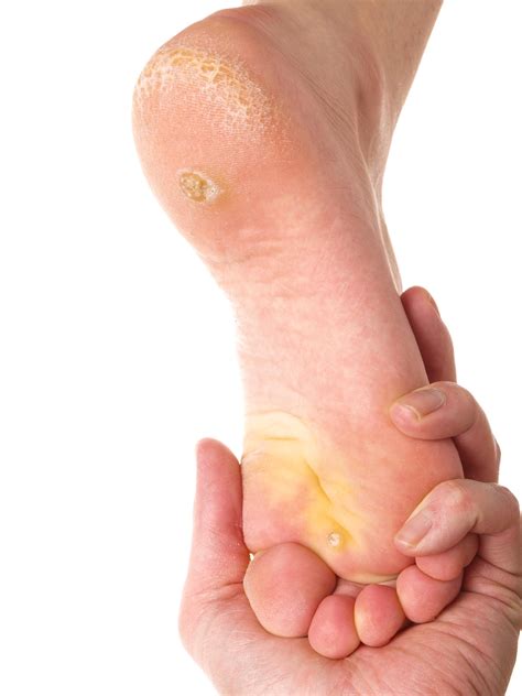 Dry skin under foot - Southern Podiatry