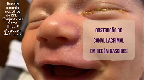 Recem Nascido Olho Amarelo