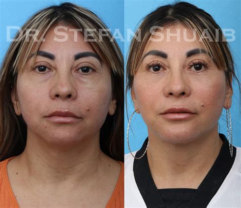 Facial Rejuvenation Archives | Dallas Facial Plastic Surgery Center