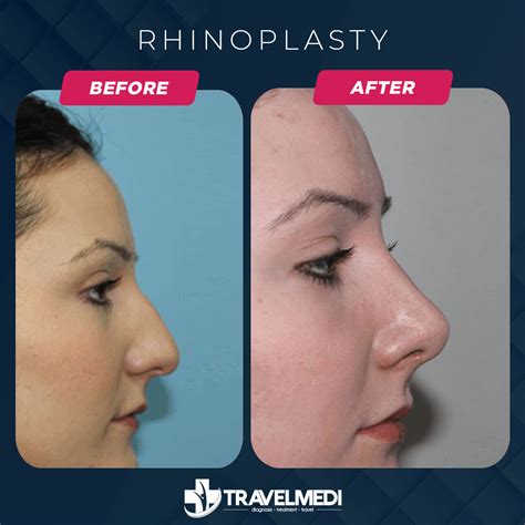 Nose Job in Turkey - Prices, Before - After 2024