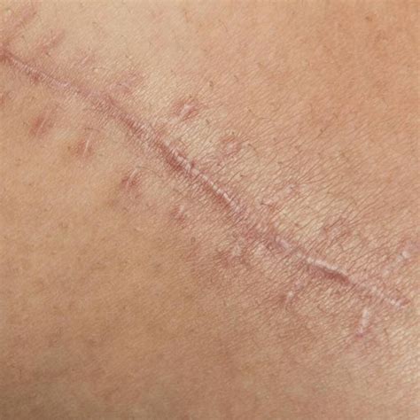 Dr Ioannis Liakas on LinkedIn: All About Treating Scars - Vie Aesthetics