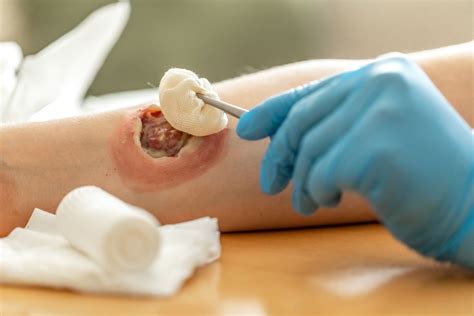 wound debridement bedside wound care  lakeland florida