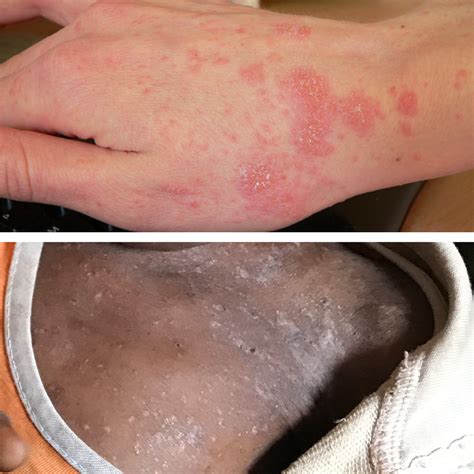 pictures  skin rashes symptoms  treatment