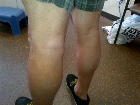 BAKER'S CYST | Sport Med School