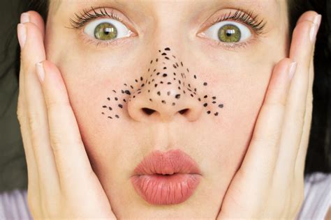 blackheads   prevention  treatment options