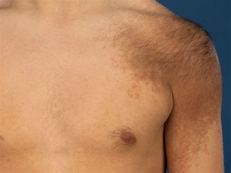 Becker's Nevus Treatment: Advantages of Laser Therapy over Plastic