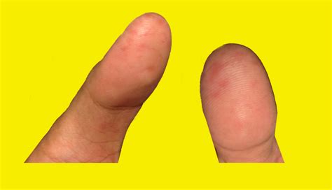 Osler Nodes Vasculitis