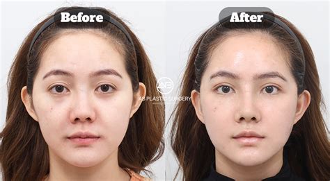facelift surgery  korea minimal scars maximum lift   ab