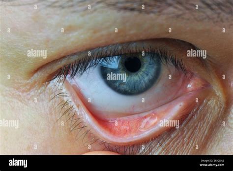 Conjunctiva Of Eye Anatomy