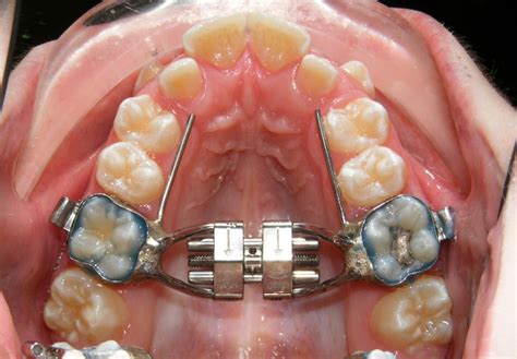 It's a mouth expander to make room for teeth when you get braces ...