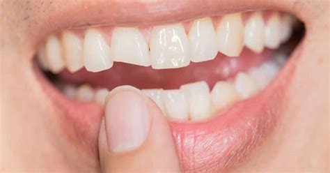 Сломался зуб. Что делать? | DENTAL-INFO