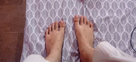 Ask a General Physician Online for Black Spots On Feet