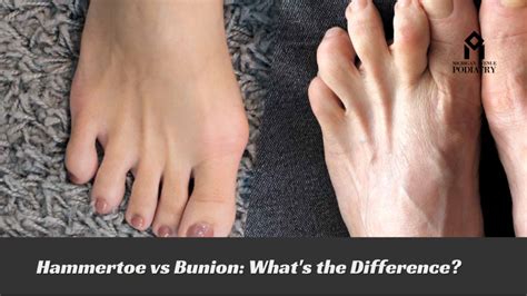 8 Best Exercises For Bunions, Pain Relief, And Post-Op Healing