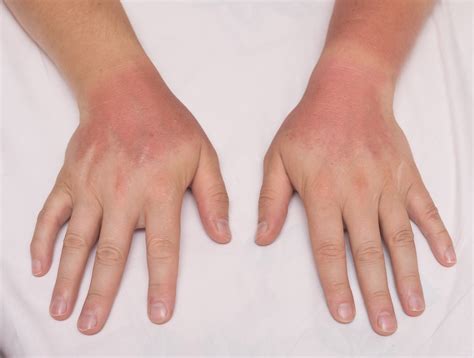 Rheumatoid Arthritis Medications & Sun Exposure - Rheumatology Advisor