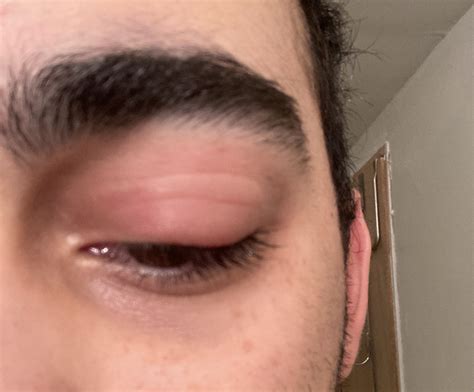 Eye Swelling Dupixent at Lucy Haire blog