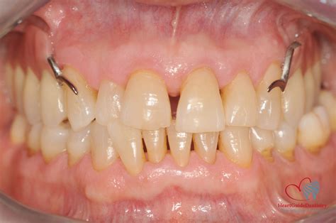 CRESTAL REGENERATION WITH DENTAL PARTICULATE GRAFT PRODUCED BY TOOTH