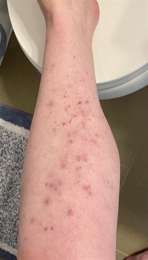 Folliculitis scarring/pigmentation - how can I help it heal